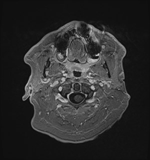 Neurofibromatosis type 2 (Radiopaedia 79097-92049 Axial T1 C+ 17).jpg
