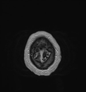 Neurofibromatosis type 2 (Radiopaedia 79097-92049 Axial T1 C+ 182).jpg