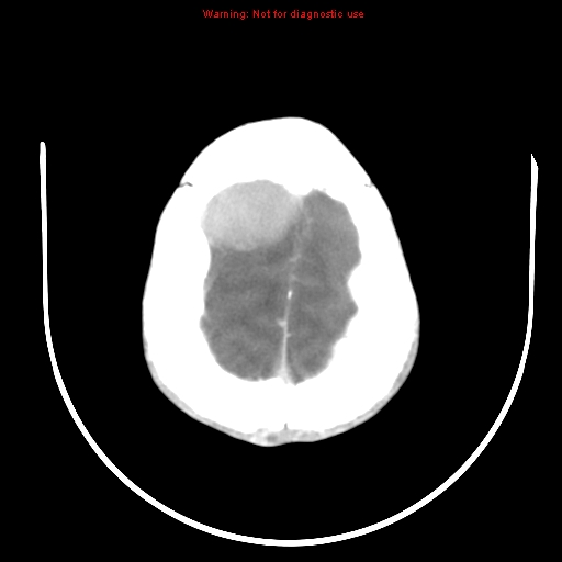 File:Neurofibromatosis type 2 (Radiopaedia 8953-9732 C 28).jpg