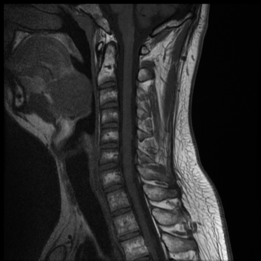 File:Neurofibromatosis type 2 (spinal manifestations) (Radiopaedia 53943-60070 Sagittal T1 6).png