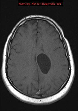 File:Neuroglial cyst (Radiopaedia 10713-11184 Axial T1 8).jpg