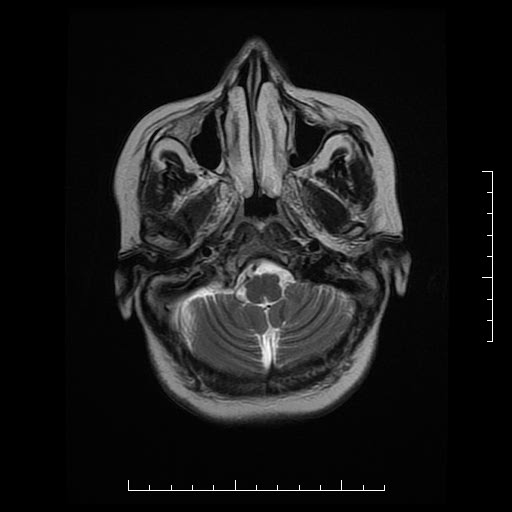 File:Neuroglial cyst of brainstem (Radiopaedia 29134-29526 Axial T2 3).jpg