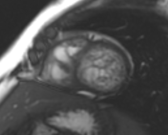 File:Non-compaction of the left ventricle (Radiopaedia 69436-79314 Short axis cine 92).jpg