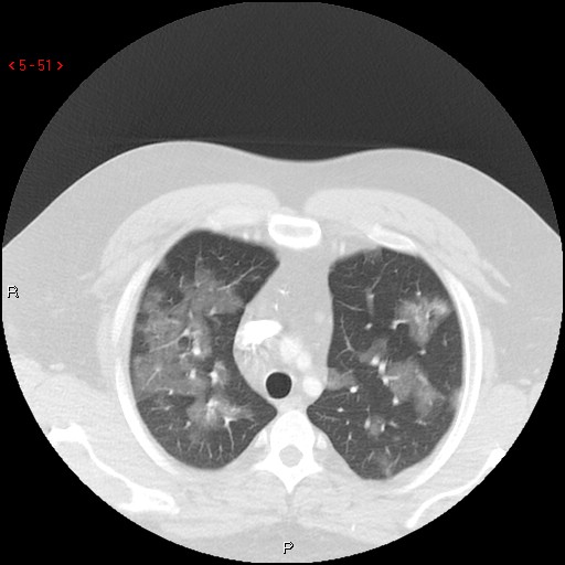 File:Non-specific interstitial pneumonitis (Radiopaedia 27044-27222 Axial lung window 42).jpg