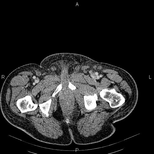 File:Non Hodgkin lymphoma in a patient with ankylosing spondylitis (Radiopaedia 84323-99621 B 67).jpg