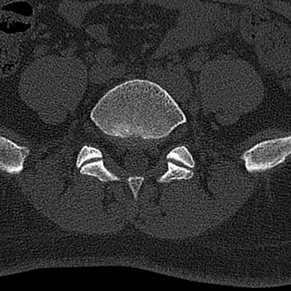 File:Normal CT lumbar spine (Radiopaedia 53981-60118 Axial bone window 61).jpg