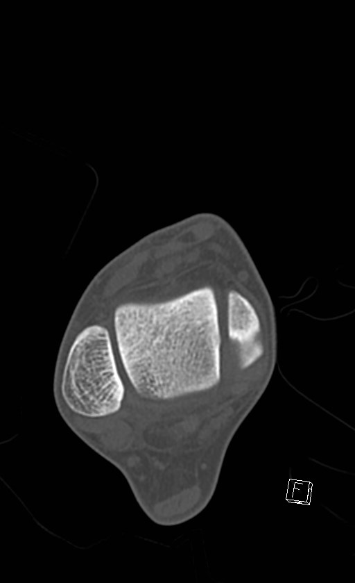 Normal CT of the ankle (Radiopaedia 47111-51658 Axial bone window 42).jpg
