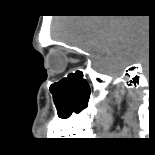 Normal CT paranasal sinuses (Radiopaedia 42286-45390 F 101).jpg