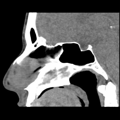 Normal CT paranasal sinuses (Radiopaedia 42286-45390 F 78).jpg