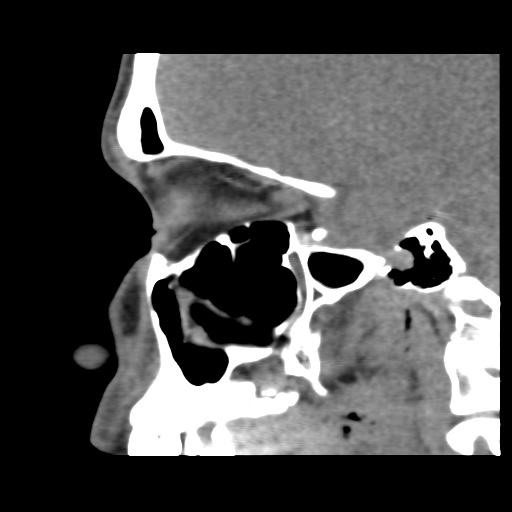 Normal CT paranasal sinuses (Radiopaedia 42286-45390 F 95).jpg
