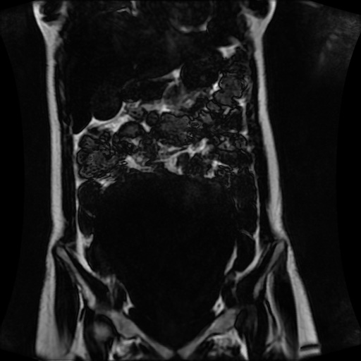 Normal MRI abdomen in pregnancy (Radiopaedia 88001-104541 N 55).jpg