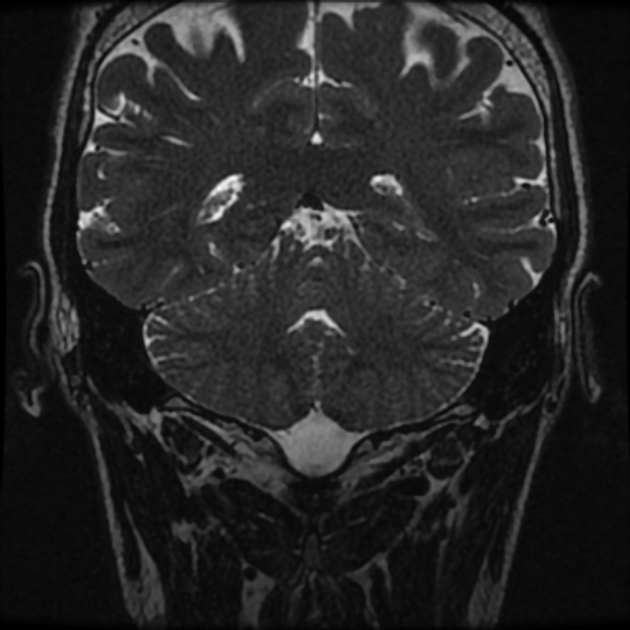 Normal MRI petrous (Radiopaedia 91317-108949 Coronal T2 93).jpg