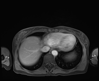 Normal adrenal glands MRI (Radiopaedia 82017-96004 M 9).jpg