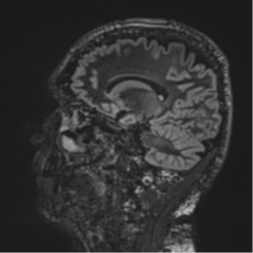 Normal brain MRI (non-focal epilepsy protocol) (Radiopaedia 53917-60040 Sagittal DIR 27).png