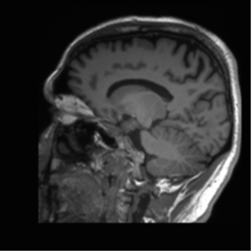 Normal brain MRI (non-focal epilepsy protocol) (Radiopaedia 53917-60040 Sagittal T1 41).png