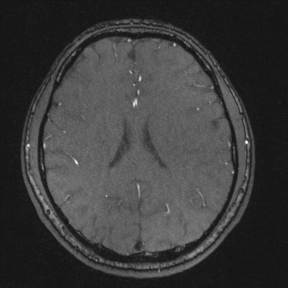 Normal brain MRI including MRA (Radiopaedia 48748-53763 Axial MRA 140).jpg