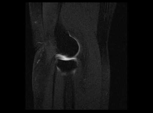 File:Normal elbow arthrograms (Radiopaedia 75550-86805 Sagittal T1 fat sat 5).jpg