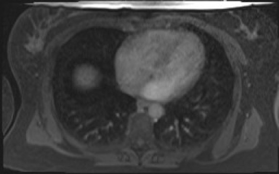 File:Normal hepatobiliary phase liver MRI (Radiopaedia 58968-66230 A 7).jpg