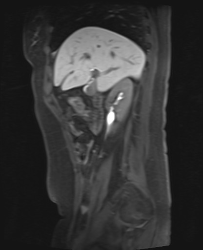 File:Normal hepatobiliary phase liver MRI (Radiopaedia 58968-66230 C 26).jpg