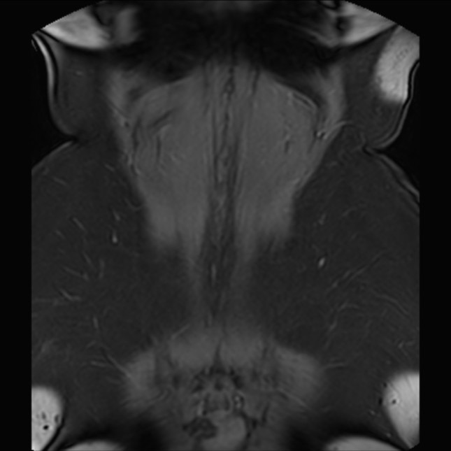 Normal liver MRI with Gadolinium (Radiopaedia 58913-66163 P 79).jpg
