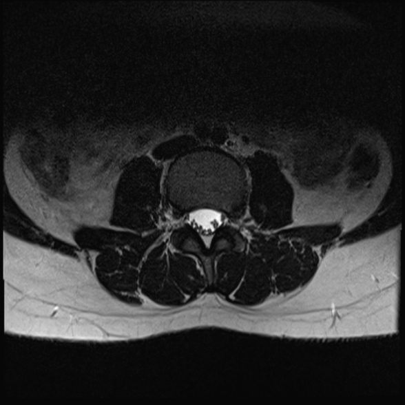 File:Normal lumbar spine MRI- 3 T (Radiopaedia 53280-59250 Axial T2 10).jpg
