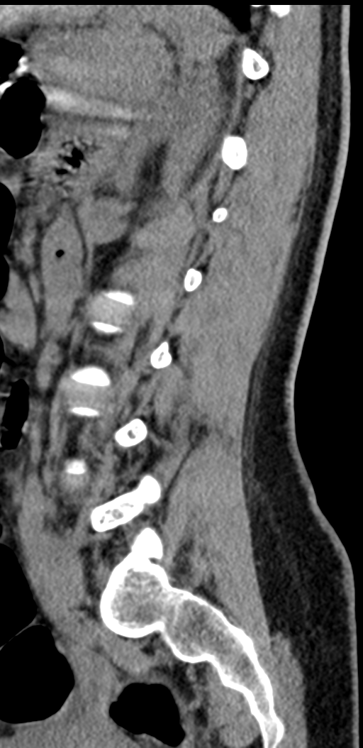 Normal lumbosacral CT (Radiopaedia 37923-39867 E 39).png