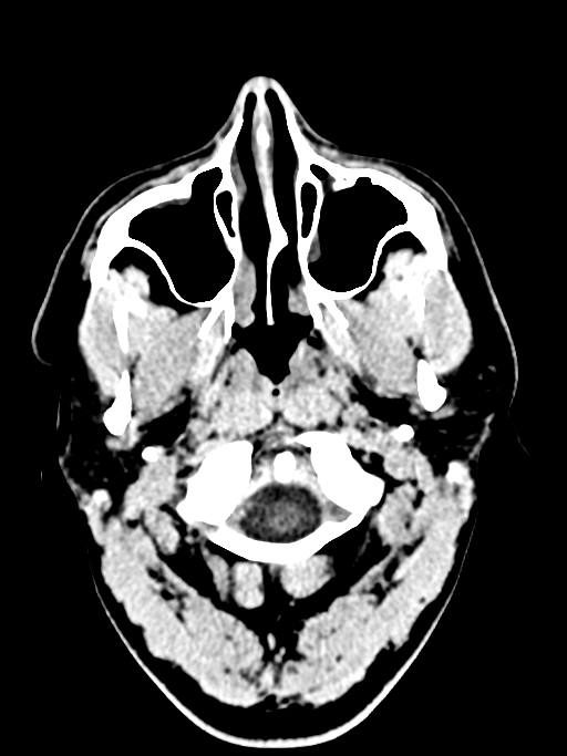 Normal trauma protocol brain and C-spine CT (Radiopaedia 83302-97709 Axial non-contrast 68).jpg