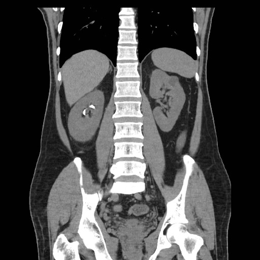 File:Obstructed kidney with perinephric urinoma (Radiopaedia 26889-27067 Coronal non-contrast 17).jpg