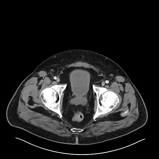 Obstructing sigmoid adenocarcinoma (Radiopaedia 58465-65619 A 153).jpg