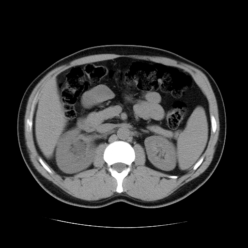 File:Obstructing ureteric calculus (Radiopaedia 18615-18514 Axial non-contrast 21).jpg