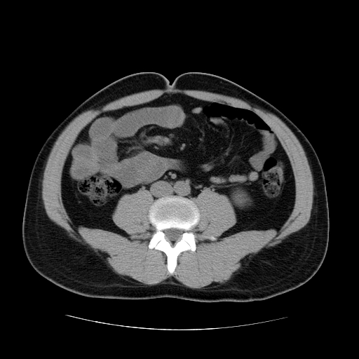 File:Obstructing ureteric calculus (Radiopaedia 18615-18514 Axial non-contrast 32).jpg