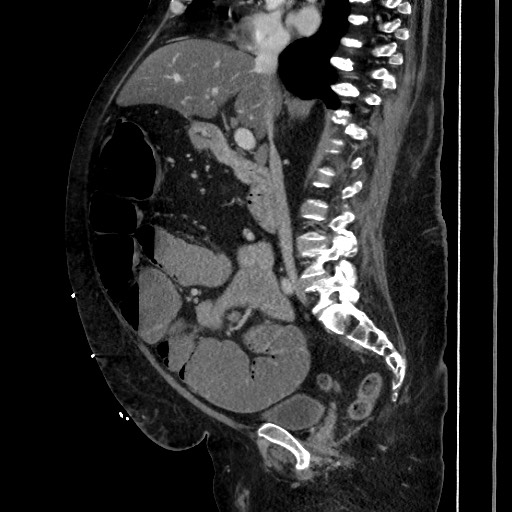 Obstructive colonic diverticular stricture (Radiopaedia 81085-94675 C 113).jpg
