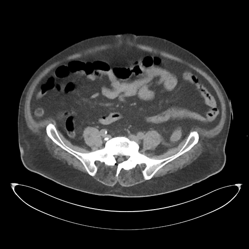 File:Obstructive pyelonephritis (Radiopaedia 46411-50844 Axial non-contrast 53).png