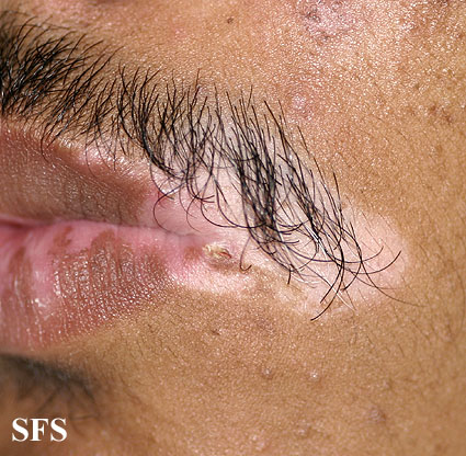 File:Vitiligo (Dermatology Atlas 32).jpg