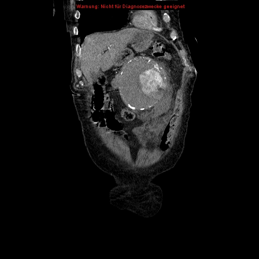 Abdominal aortic aneurysm- extremely large, ruptured (Radiopaedia 19882-19921 Coronal C+ arterial phase 22).jpg