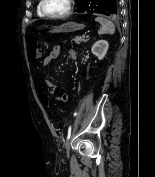 Abdominal aortic aneurysm (Radiopaedia 25855-26001 Sagittal C+ arterial phase 54).jpg