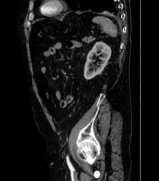 Abdominal aortic aneurysm (Radiopaedia 25855-26001 Sagittal C+ arterial phase 64).jpg