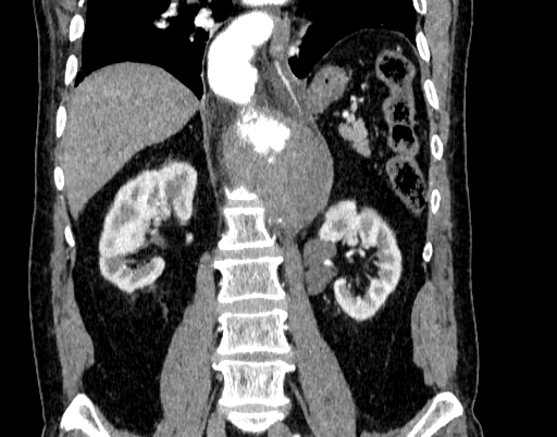 Abdominal aortic aneurysm (Radiopaedia 67117-76452 Coronal C+ arterial phase 64).jpg