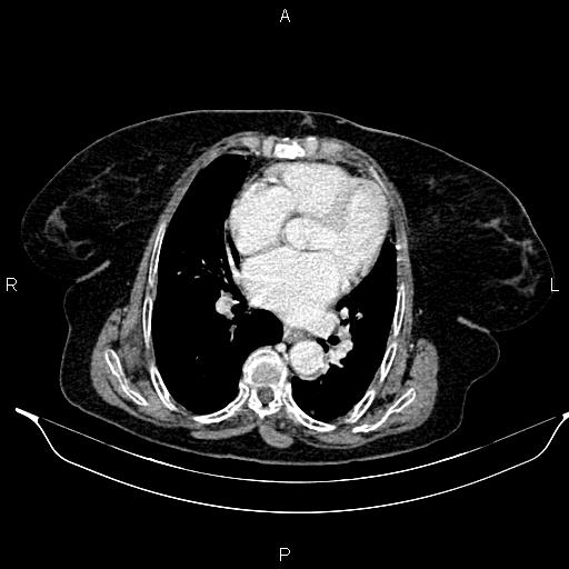 File:Abdominal aortic aneurysm (Radiopaedia 85063-100606 Axial C+ portal venous phase 20).jpg