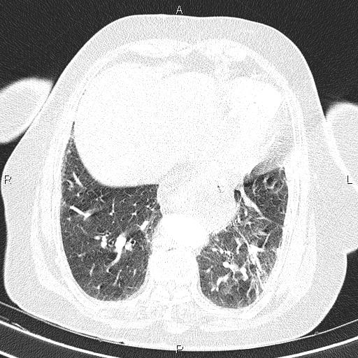 Abdominal aortic aneurysm (Radiopaedia 85063-100606 Axial lung window 48).jpg