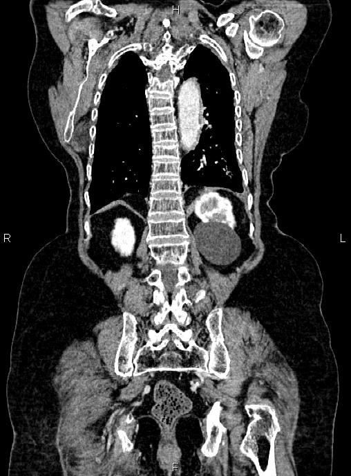 Abdominal aortic aneurysm (Radiopaedia 85063-100606 Coronal C+ arterial phase 46).jpg