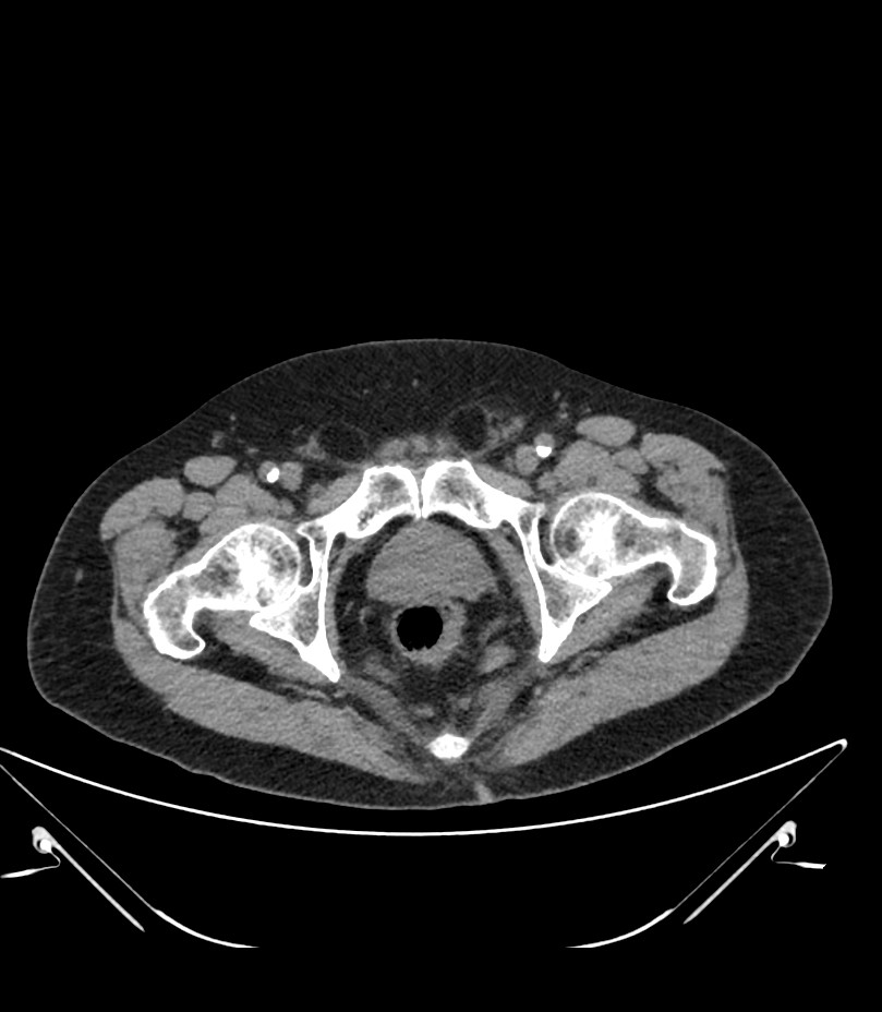 Abdominal aortic aneurysm with thrombus fissuration (Radiopaedia 46218-50618 Axial non-contrast 57).jpg