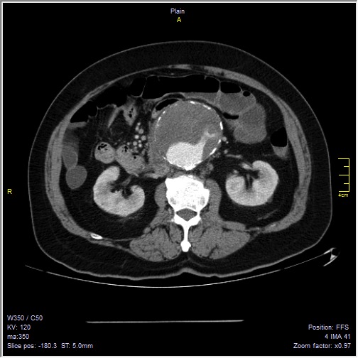 Abdominal aortic aneurysm with thrombus fissuration (Radiopaedia 47340-51926 Axial C+ arterial phase 25).jpg