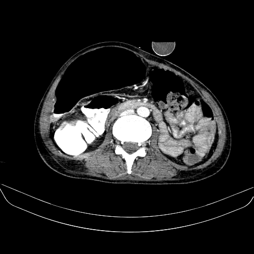 File:Abdominal collection due to previous cecal perforation (Radiopaedia 80831-94320 Axial C+ portal venous phase 105).jpg
