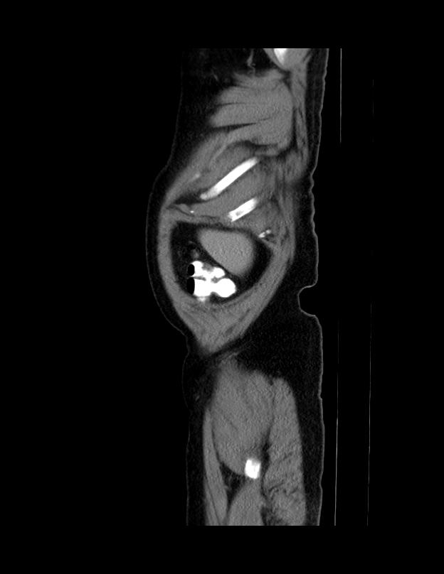 Abdominal lymphoma - with sandwich sign (Radiopaedia 53486-59492 Sagittal C+ portal venous phase 76).jpg
