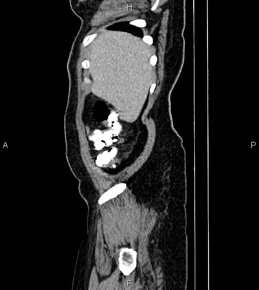 Abdominal lymphoma with sandwich sign (Radiopaedia 84378-99704 Sagittal C+ portal venous phase 2).jpg