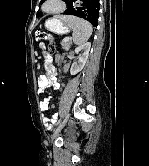 Abdominal lymphoma with sandwich sign (Radiopaedia 84378-99704 Sagittal C+ portal venous phase 64).jpg