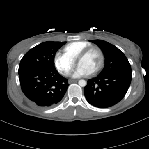 File:Abdominal multi-trauma - devascularised kidney and liver, spleen and pancreatic lacerations (Radiopaedia 34984-36486 Axial C+ arterial phase 55).png
