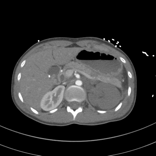 Abdominal multi-trauma - devascularised kidney and liver, spleen and pancreatic lacerations (Radiopaedia 34984-36486 Axial C+ arterial phase 97).png