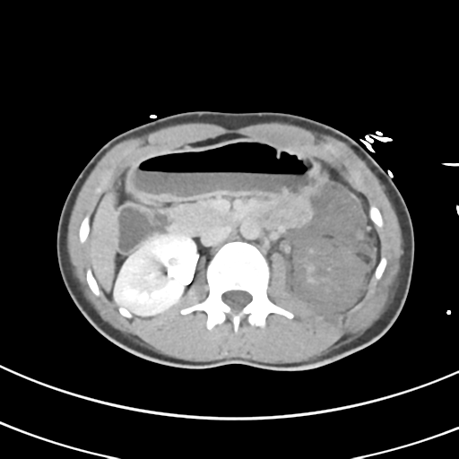 File:Abdominal multi-trauma - devascularised kidney and liver, spleen and pancreatic lacerations (Radiopaedia 34984-36486 Axial C+ delayed 31).png